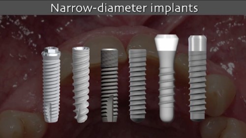 Implication of different implant types 